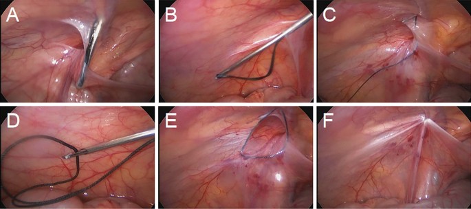 Laparoscopic Hernia Repair