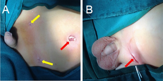 A comparative study examining laparoscopic and open inguinal hernia repair in children: a retrospective study from a single center in China | BMC Surgery | Full Text A comparative study examining laparoscopic and open inguinal hernia repair in children: a retrospective study from a single center in China | BMC Surgery | Full Text