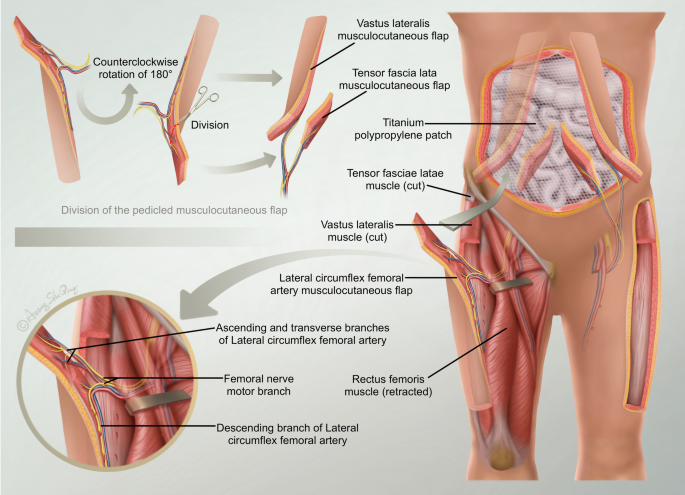 Jersey Colorectal Group - Femoral Hernia Repair