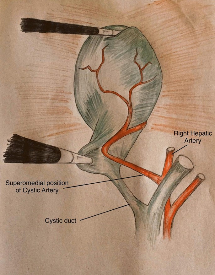 cystic duct