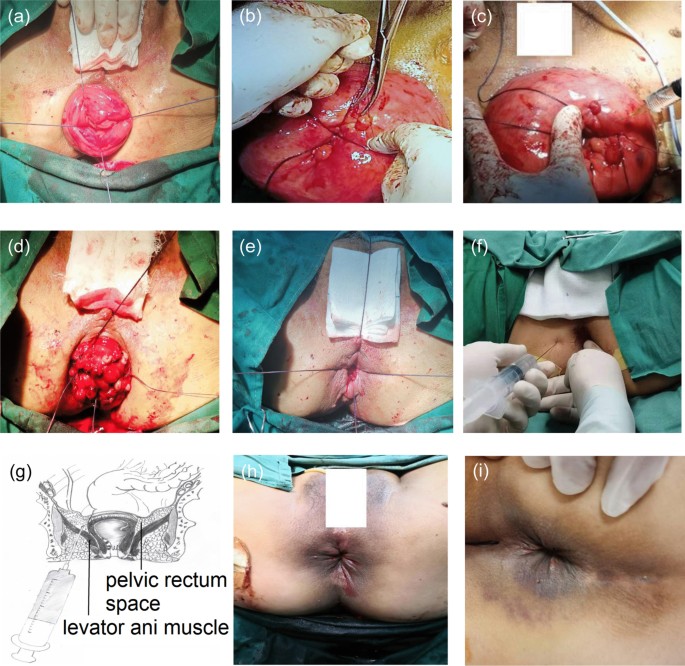 A new modified Gant-Miwa-Thiersch combined with submucosal and perirectal  sclerosant injection procedure for full-thickness rectal prolapse in  elderly women: clinical analysis of 34 cases | BMC Surgery | Full Text