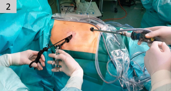 Port Position of Various Thoracoscopic Surgeries