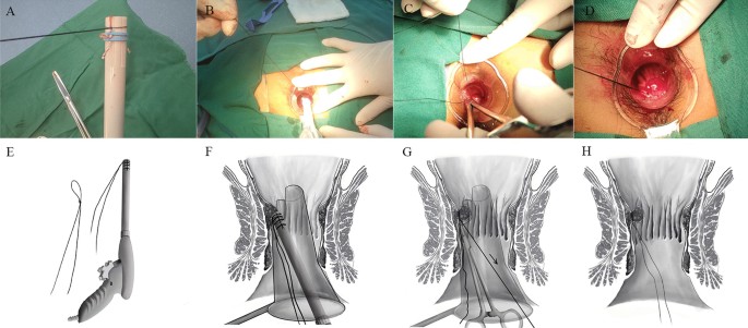 Modified rubber band ligation for treatment of grade II/III hemorrhoids:  clinical efficacy and safety evaluation—a retrospective study | BMC Surgery  | Full Text