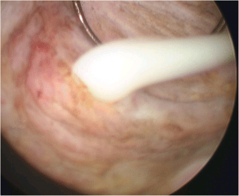 prostatic abscess symptoms)