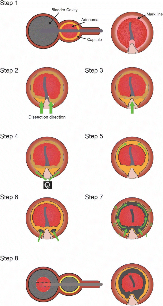 Safety and effectiveness of high-power thulium laser enucleation of the  prostate in patients with glands larger than 80 mL | BMC Urology | Full Text