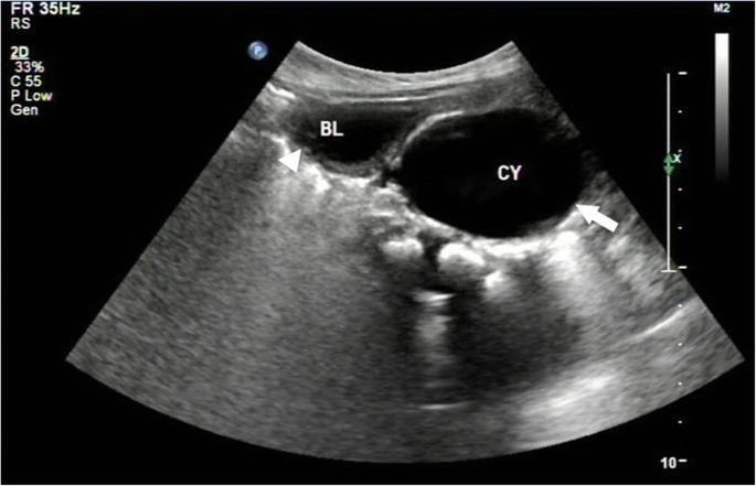 Prostatic utricles without external