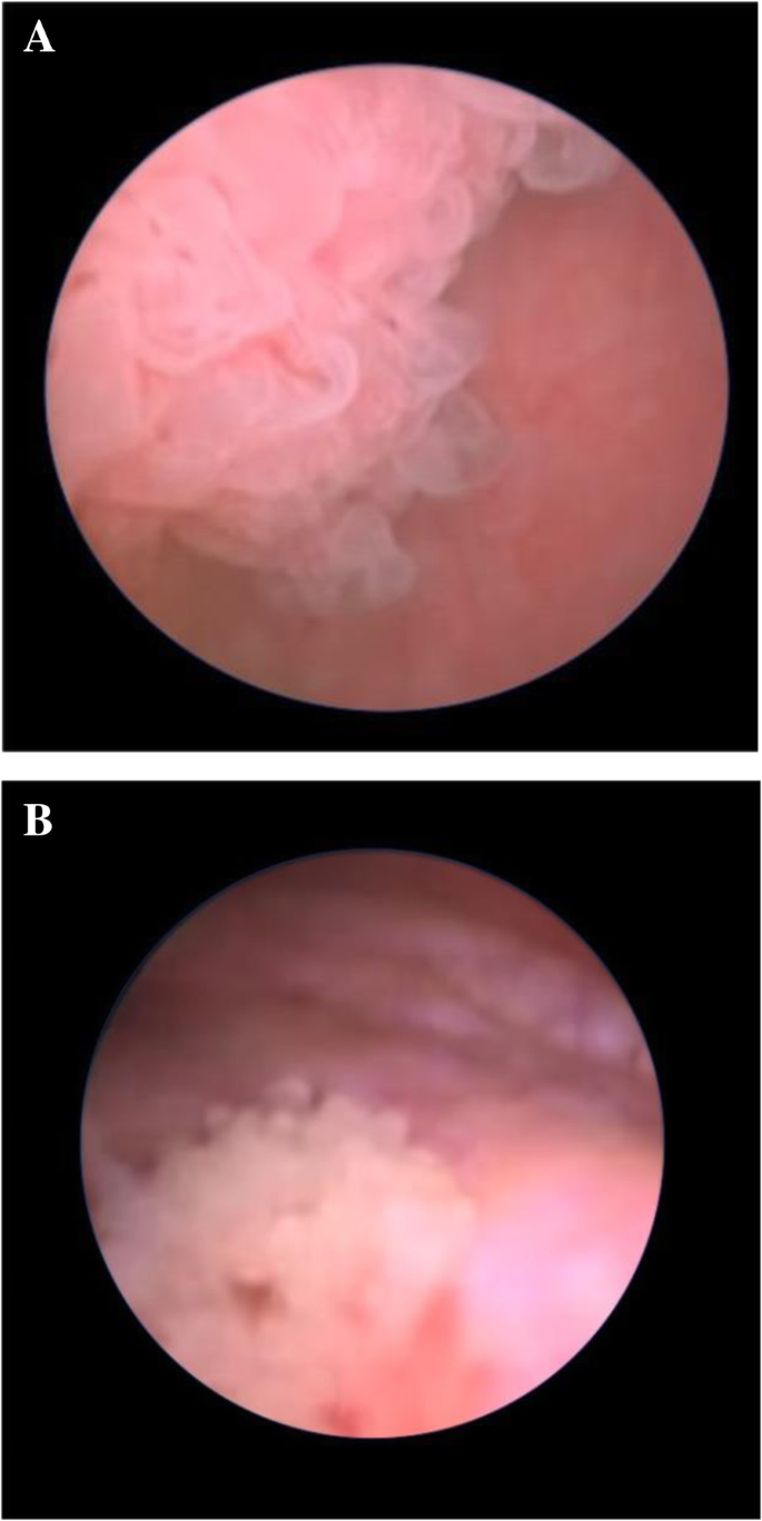 papillary urothelial tumor