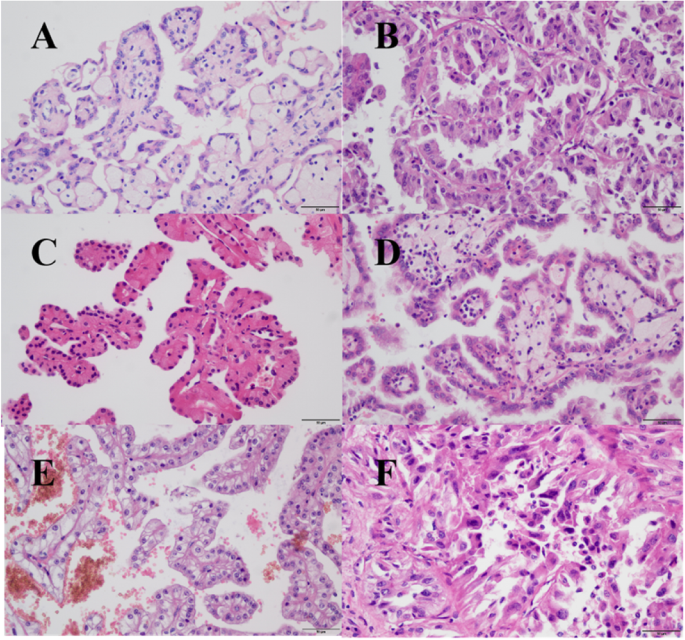 Comparison of clinicopathologic parameters and oncologic outcomes between type 1 and type 2 papillary renal cell carcinoma | BMC Urology | Full Text Comparison of clinicopathologic parameters and oncologic outcomes between type 1 and type 2 papillary renal cell carcinoma | BMC Urology | Full Text