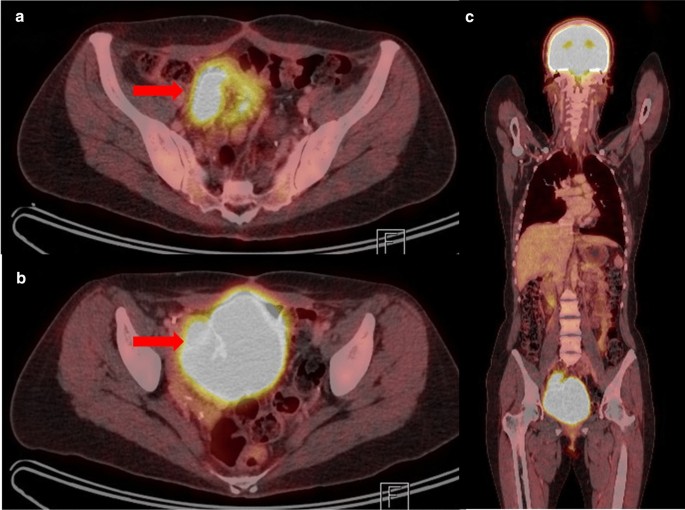 neobladder ultrasound