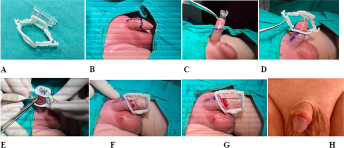 Comparative analysis of two methods in circumcision: a new 