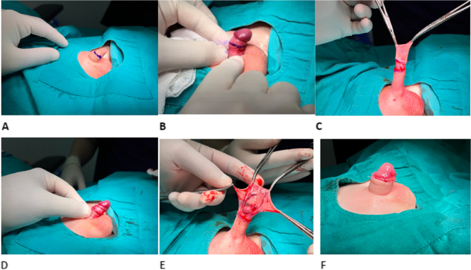Comparative analysis of two methods in circumcision: a new 