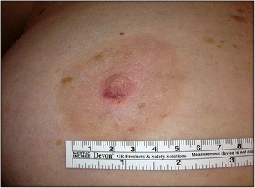 Right breast at initial presentation. Erosion and redness of the nipple