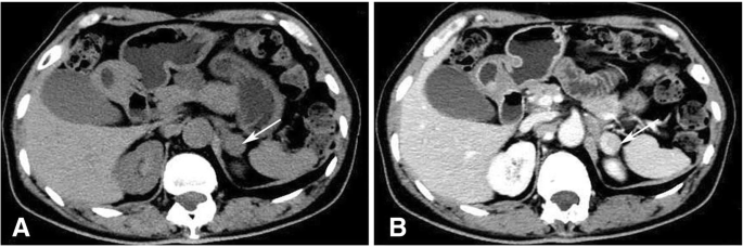 A rare case of pure testosterone-secreting adrenal adenoma in a  postmenopausal elderly woman | BMC Endocrine Disorders | Full Text
