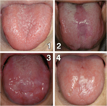 atrophic candidiasis