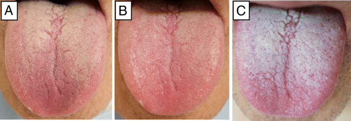 Clinical observation of tongue coating of perioperative patients: factors  related to the number of bacteria on the tongue before and after surgery |  BMC Oral Health | Full Text