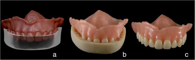 Intraoral scanning to fabricate complete dentures with functional borders:  a proof-of-concept case report | BMC Oral Health | Full Text