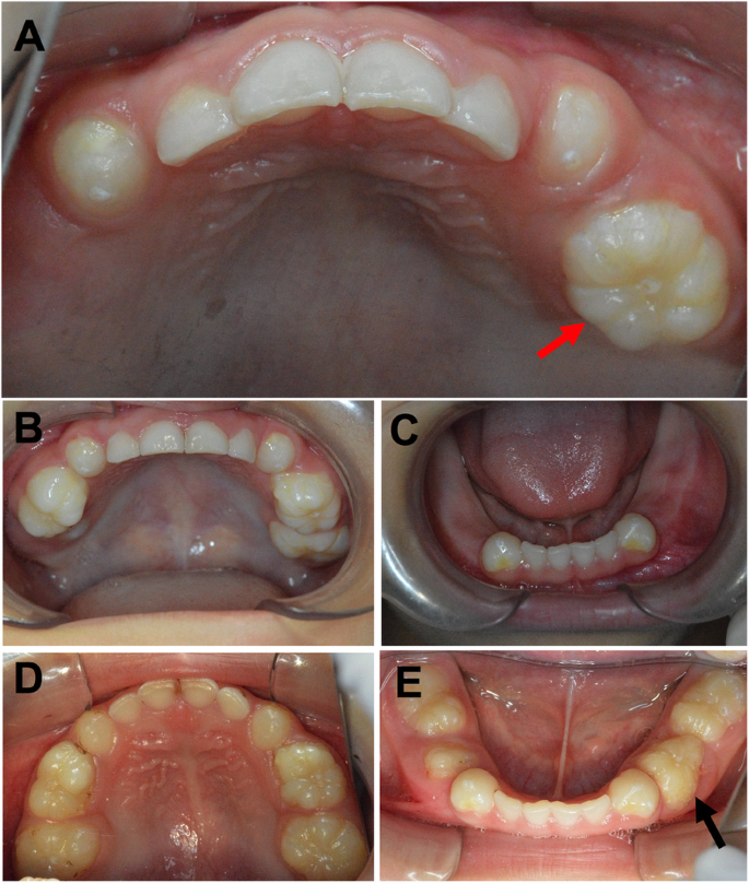 4 year old molars