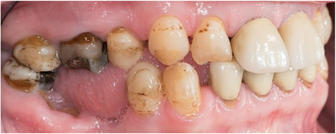 Dental Anomalies And Orthodontic Characteristics In Patients With Pseudohypoparathyroidism Bmc Oral Health Full Text