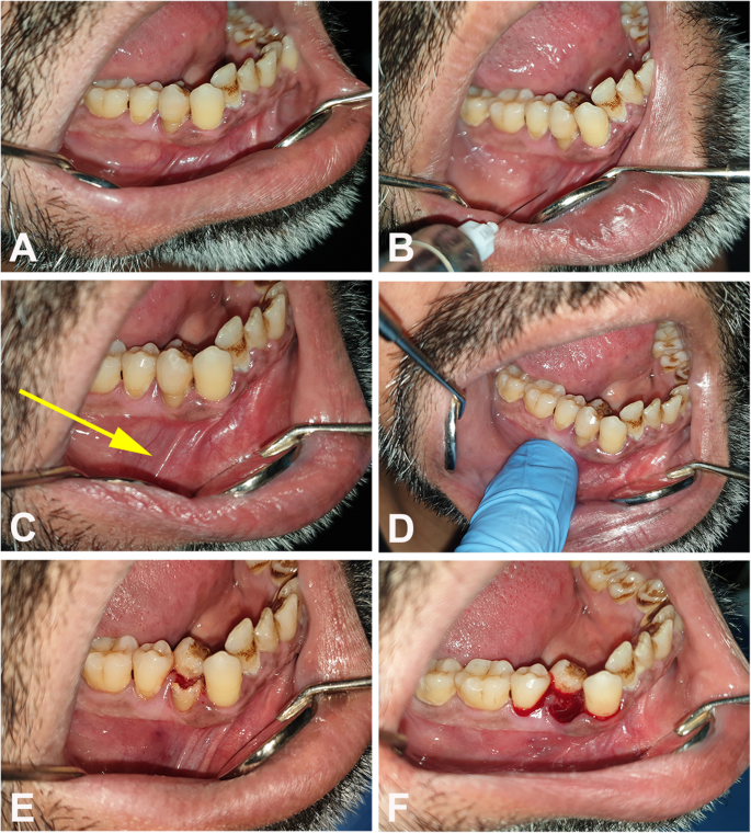 The success of using 2% lidocaine in pain removal during extraction of  mandibular premolars: a prospective clinical study | BMC Oral Health | Full  Text