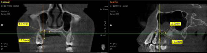 Maxillary epithelioid hemangioendothelioma: an especially rare malignant  tumor mimicking periodontal disease | BMC Oral Health | Full Text