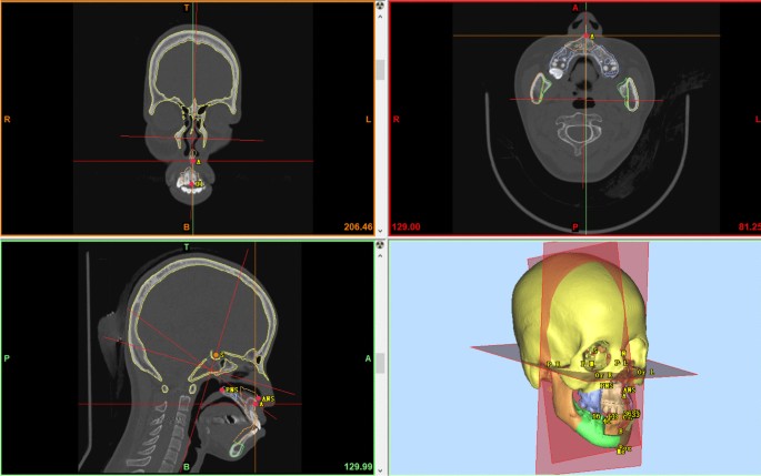 Accuracy of virtual surgical planning in segmental osteotomy in combination  with bimaxillary orthognathic surgery with surgery first approach | BMC  Oral Health | Full Text