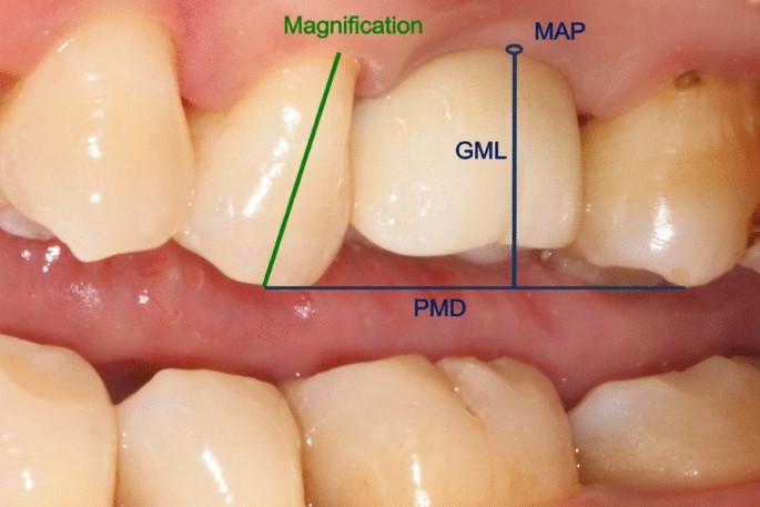 Radiographic evaluation of a cross-shaped incision technique for thick- gingiva and thin-gingiva patients treated with implant-supported fixed  prosthesis | BMC Oral Health | Full Text