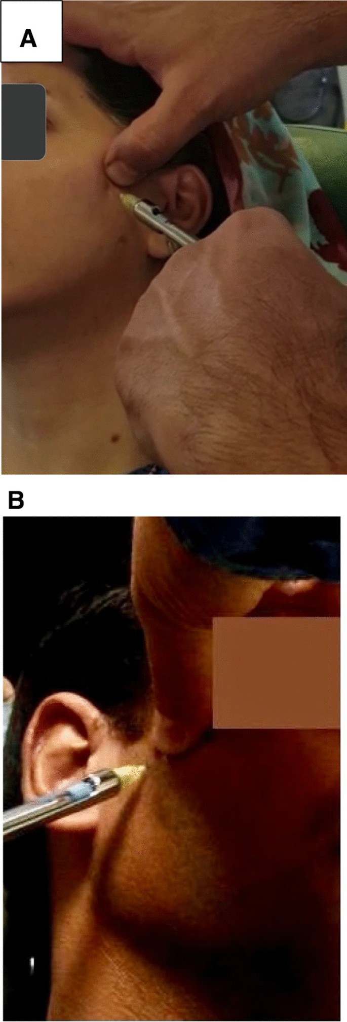 The effects of botulinum toxin A injection on the lateral pterygoid muscle  in patients with a painful temporomandibular joint click: a randomized  clinical trial study | BMC Oral Health