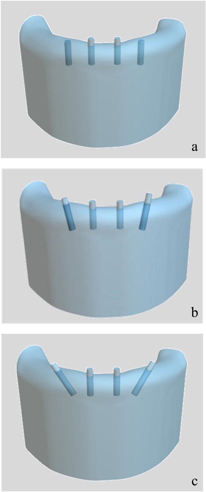 Biomechanical comparison of different prosthetic materials and posterior  implant angles in all-on-4 treatment concept by three-dimensional finite  element analysis