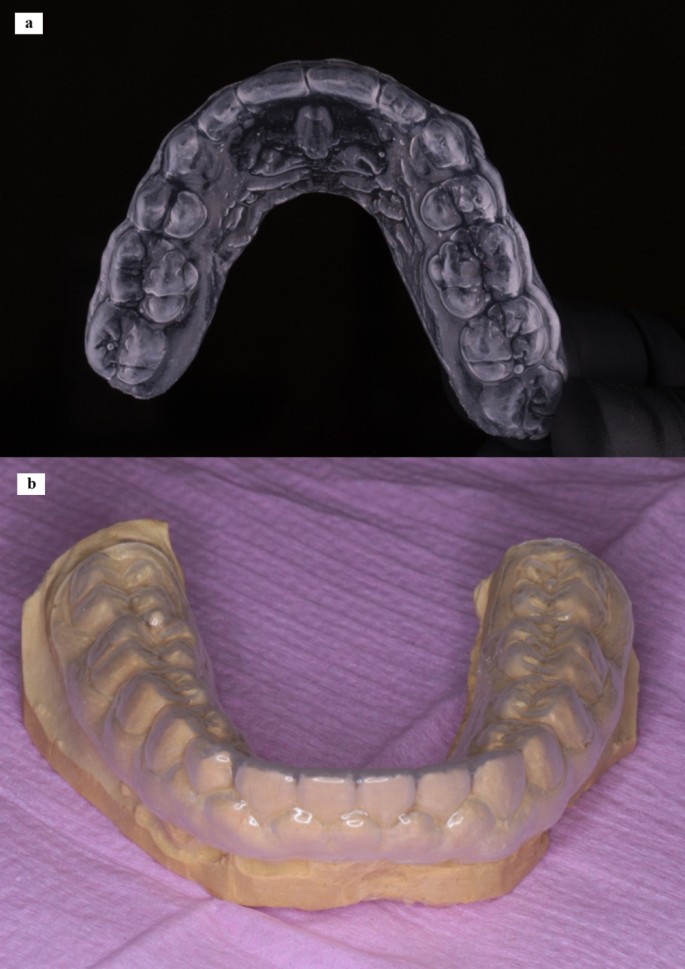 EFFECT OF GINGIVECTOMY ON MEAN EXPOSED LINGUAL OR PALATAL ROOT SURFACE