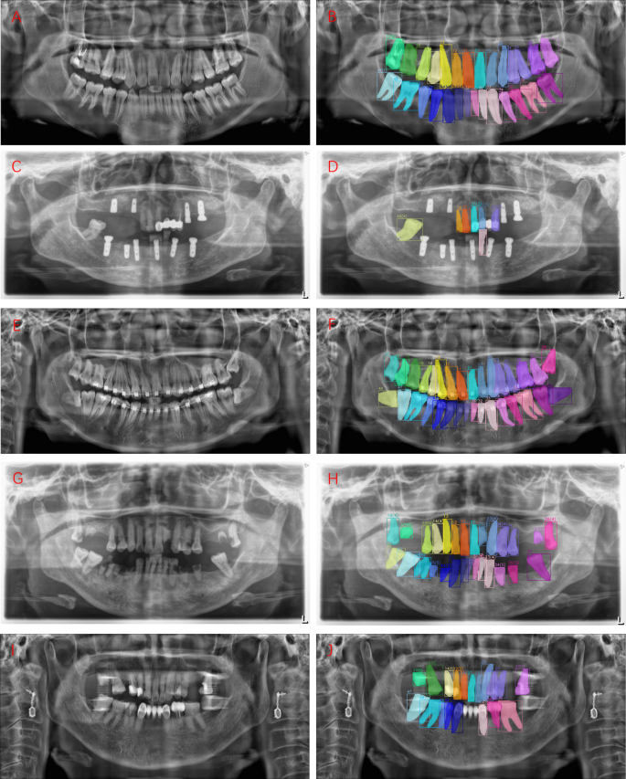 A duallabeled dataset and fusion model for automatic teeth