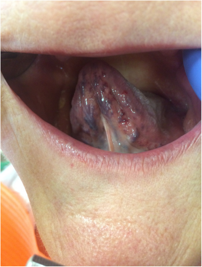 hepatitis c on lips Oral manifestations in patients with chronic hepatitis C | BMC Oral Health