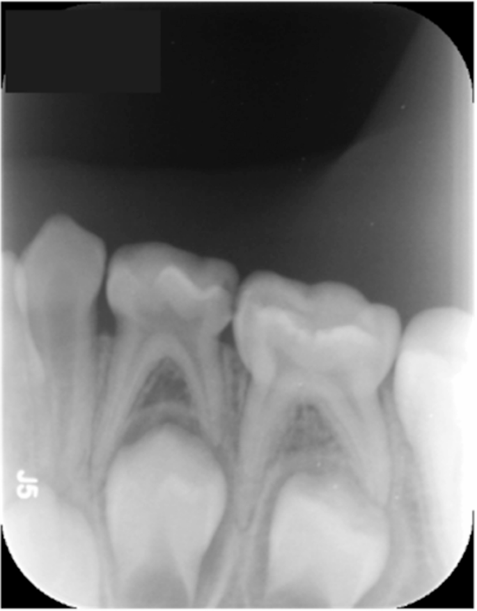 Radiographic analysis of primary first molars in pediatric dentistry: a ...