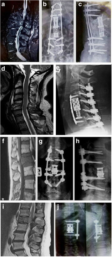 cancer of spine