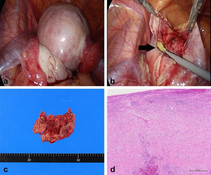 Successful laparoscopic resection of ovarian abscess caused by  Staphylococcus aureus in a 13-year-old girl: a case report and review of  literature | BMC Women's Health | Full Text