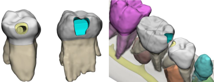ALAN Pediatric Dentistry Study Model 4002 - Children's Pathology Demonstration Tool