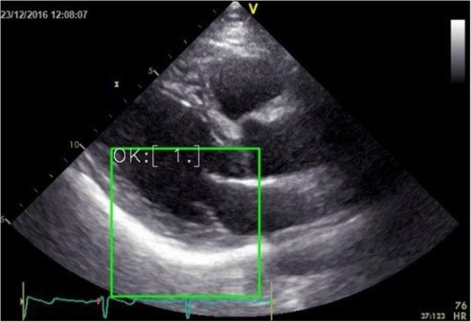 left ventricular hypertrophy echo