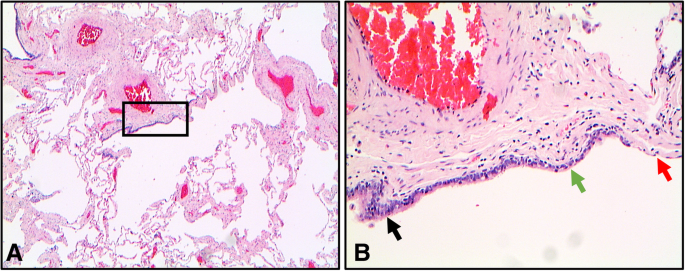 The pathology of small airways disease in COPD: historical aspects and  future directions | Respiratory Research | Full Text