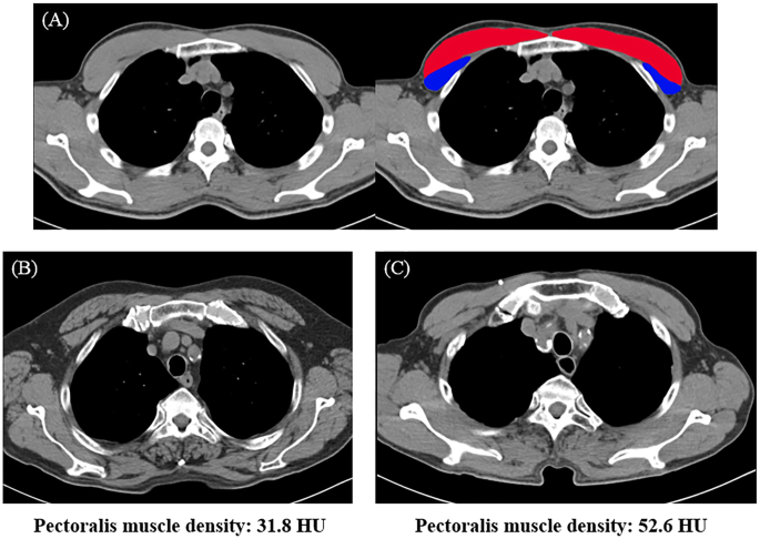 Computed tomography-derived area and density of pectoralis muscle  associated disease severity and longitudinal changes in chronic obstructive  pulmonary disease: a case control study | Respiratory Research | Full Text