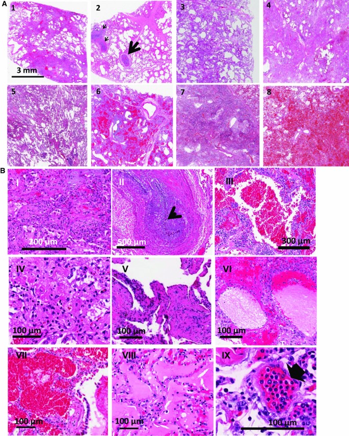 Pulmonary vascular inflammation with fatal coronavirus disease 2019  (COVID-19): possible role for the NLRP3 inflammasome, Respiratory Research