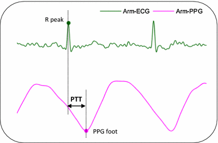 Highly Wearable Cuff Less Blood Pressure And Heart Rate Monitoring With Single Arm Electrocardiogram And Photoplethysmogram Signals Springerlink