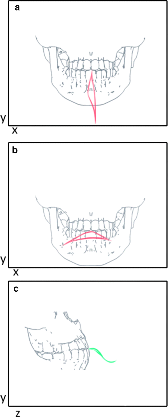 Identification Of Arthropathy And Myopathy Of The Temporomandibular Syndrome By Biomechanical Facial Features Biomedical Engineering Online Full Text