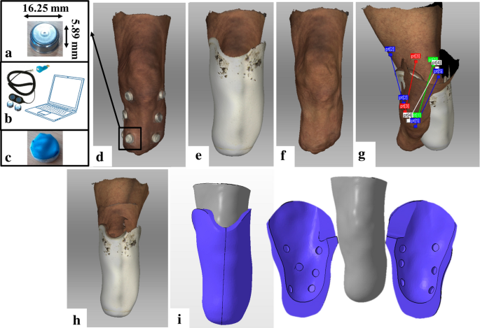 A personalised prosthetic liner with embedded sensor technology: a case  study | BioMedical Engineering OnLine | Full Text