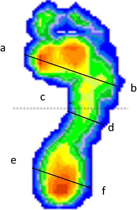 Normal neutral healthy foot compare with flat foot or fallen arch problem  with Foot print to show how entire sole of the foot to touch the floor when  stand up. Stock Photo