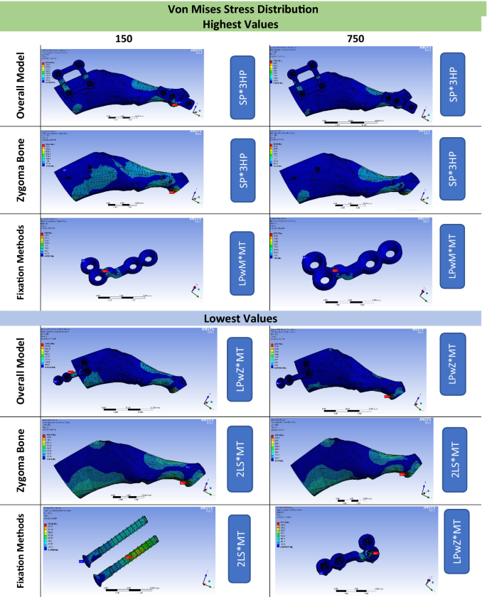 Stability of different fixation methods after reduction malarplasty under  average and maximum masticatory forces: a finite element analysis, BioMedical Engineering OnLine