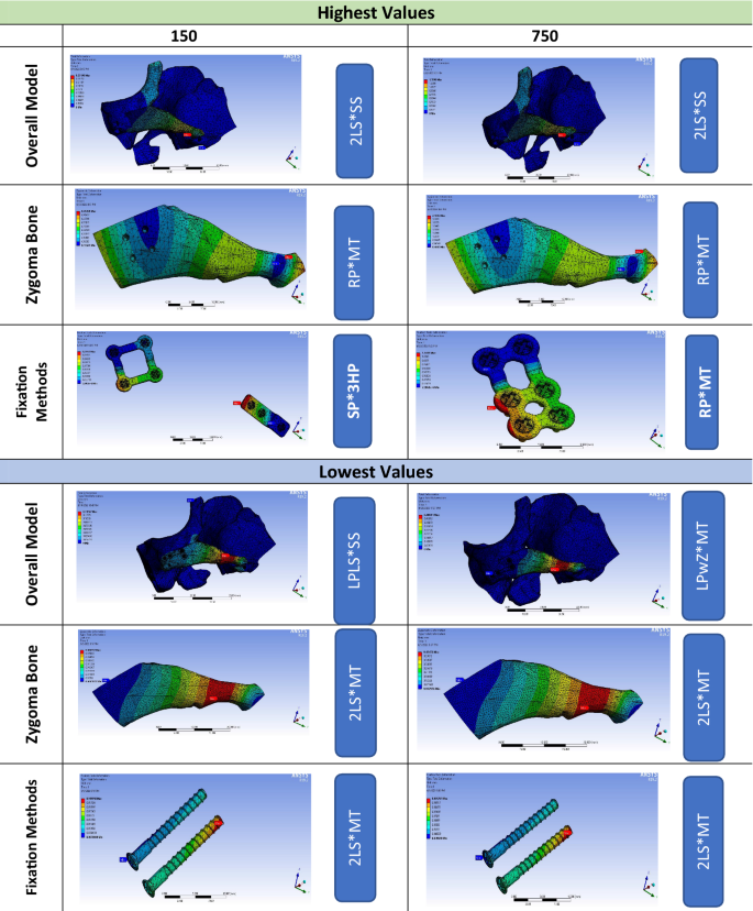 Stability of different fixation methods after reduction malarplasty under  average and maximum masticatory forces: a finite element analysis, BioMedical Engineering OnLine