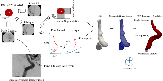 Computational hemodynamic pathophysiology of internal carotid 