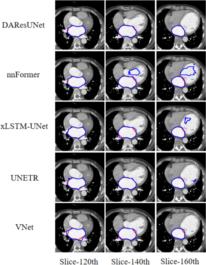 Deep learning-based cardiac computed tomography angiography left atrial ...