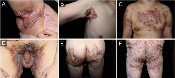 Decreased HDL-C in hidradenitis suppurativa: association with systemic inflammatory phenotype and implications for risk stratification | Lipids in Health and Disease
