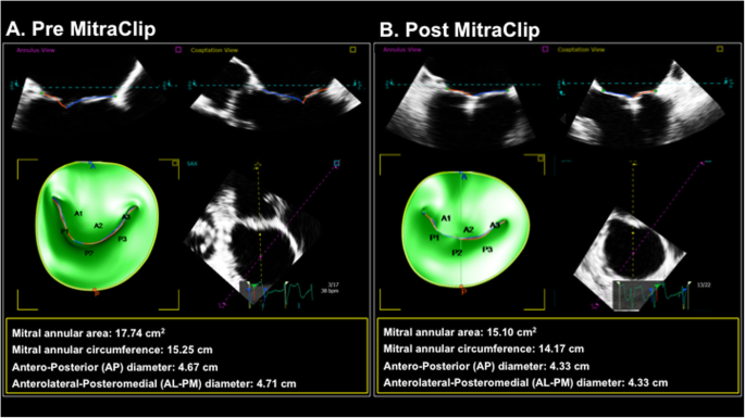 Transcatheter MitraClip repair alters mitral annular geometry – device  induced annular remodeling on three-dimensional echocardiography predicts  therapeutic response | Cardiovascular Ultrasound | Full Text