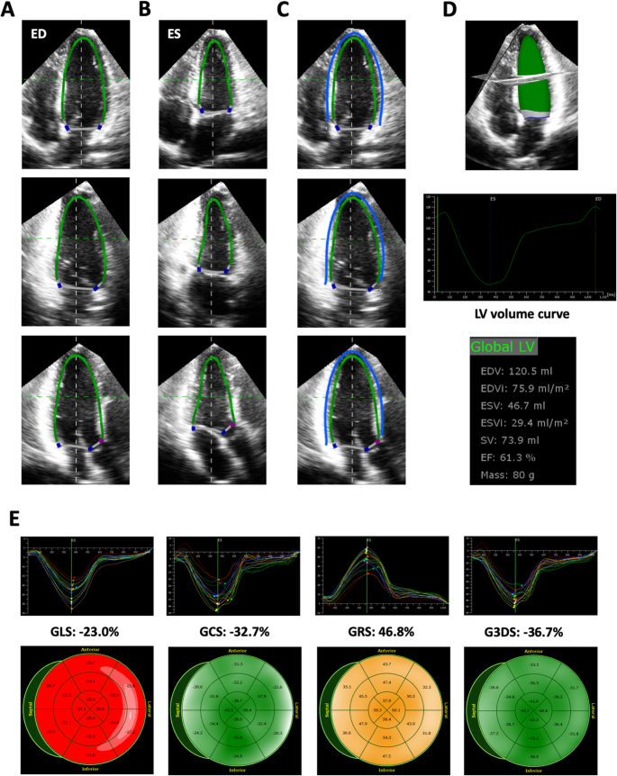 Representative longitudinal strain analysis in each vendor. Left